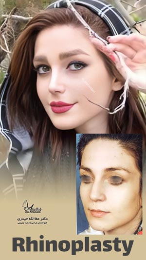 نمونه کار جراحی بینی دکتر حیدری