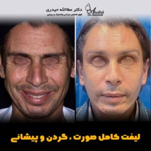 جراحی لیفت صورت - دکتر حیدری