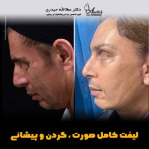 جراحی لیفت صورت - دکتر حیدری