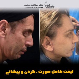 جراحی لیفت صورت - دکتر حیدری