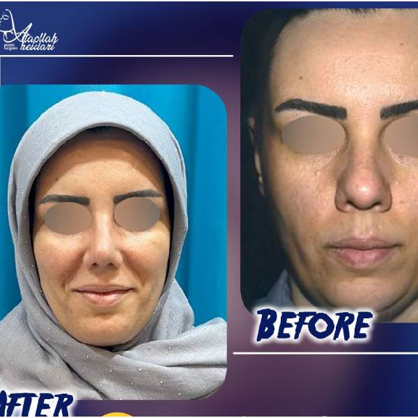 جراحی بینی گوشتی