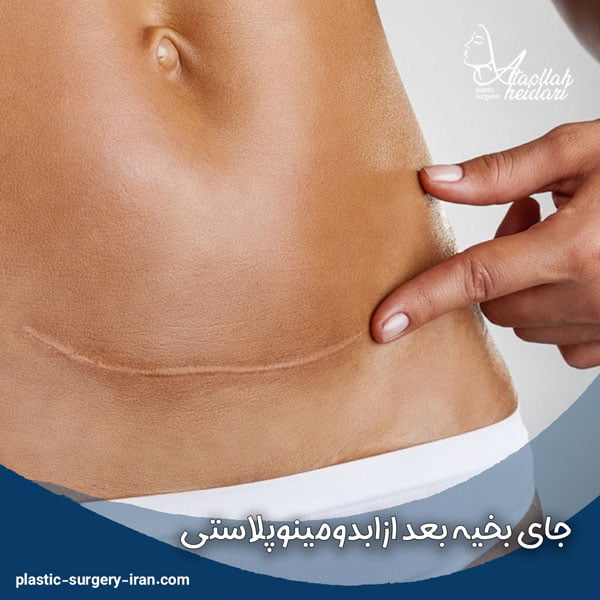 جای بخیه بعد از ابدومینوپلاستی - دکتر حیدری