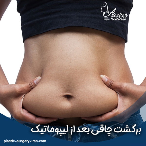 برگشت چاقی بعد از لیپوماتیک - دکتر حیدری