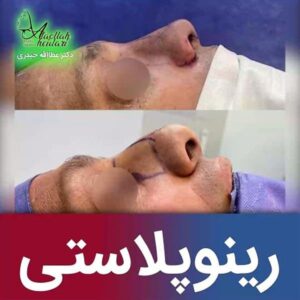 جراحی بینی گوشتی در تهران - دکتر حیدری