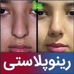 جراحی بینی گوشتی در تهران - دکتر حیدری