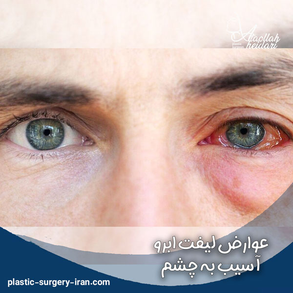 عوارض جراحی لیفت ابرو آسیب به چشم - دکتر حیدری