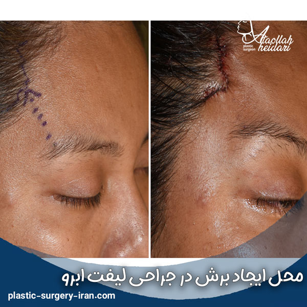 محل برش ها در روش جراحی لیفت ابرو - دکتر حیدری