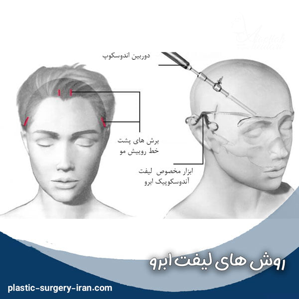 روش های لیفت ابرو - دکتر حیدری