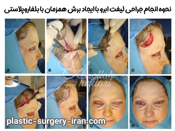 روش جراحی لیفت ابرو - دکتر حیدری