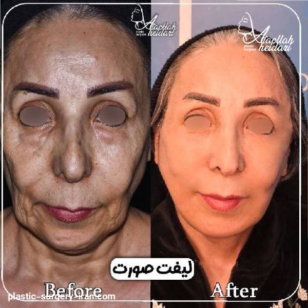 عکس نمونه کار عمل لیفت صورت