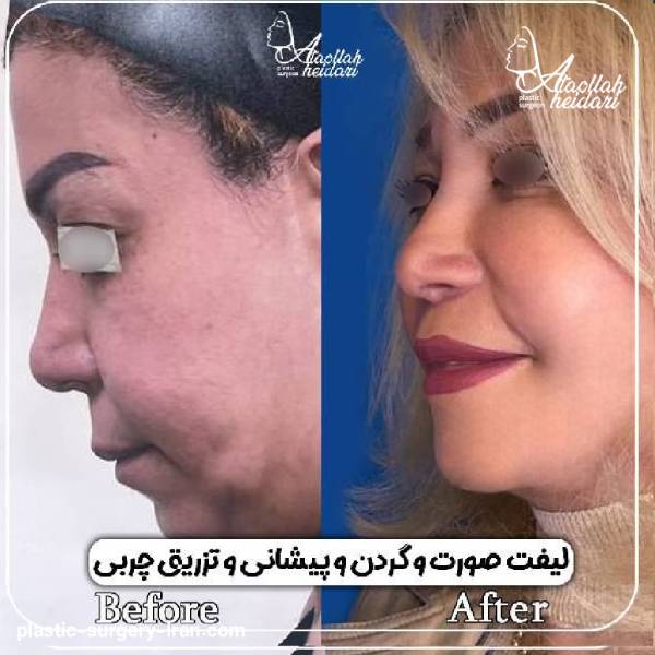 نموه کار بهترین جراح لیفت صورت