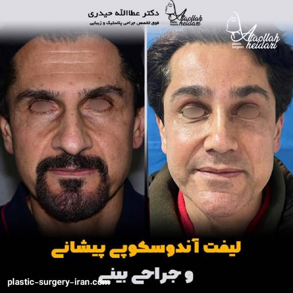 نموه کار لیفت صورت دکتر حیدری