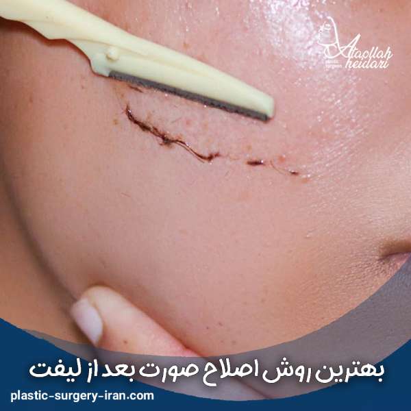 بند انداختن بعد از لیفت صورت 