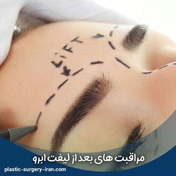 مراقبت های بعد از لیفت ابرو