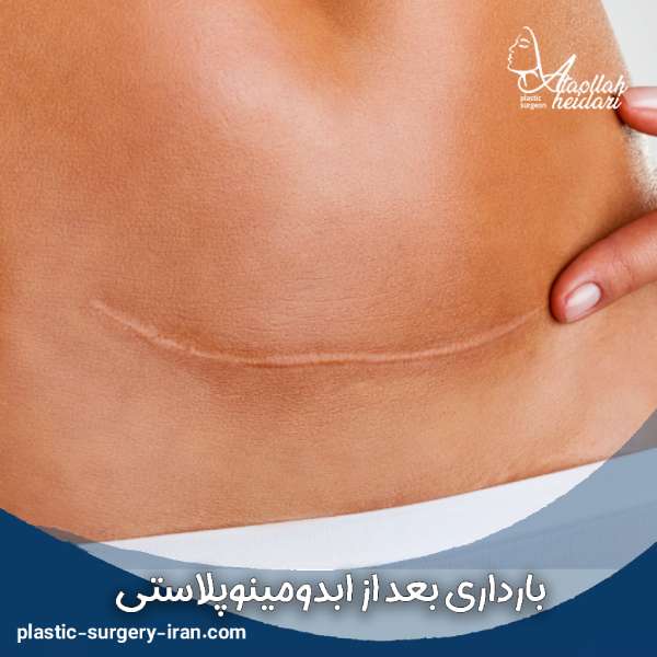 بارداری بعد از ابدومینوپلاستی
