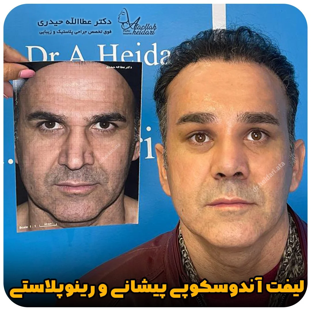 لیفت صورت و جراحی بینی