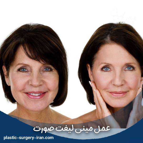 عمل مینی لیفت صورت 