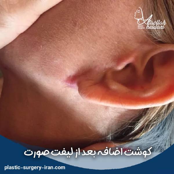 عکس جای کلوئید بعد از لیفت صورت