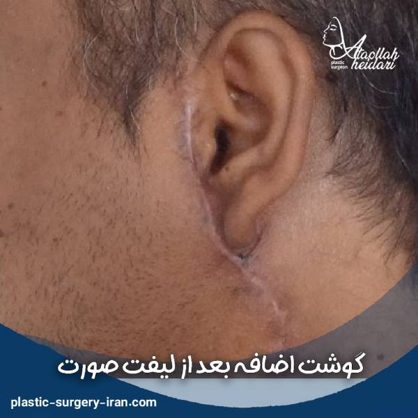 عکس گوشت اضافه بعد از لیفت صورت