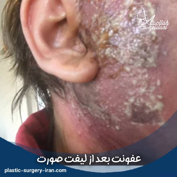 عکس عفونت بعد از لیفت صورت 