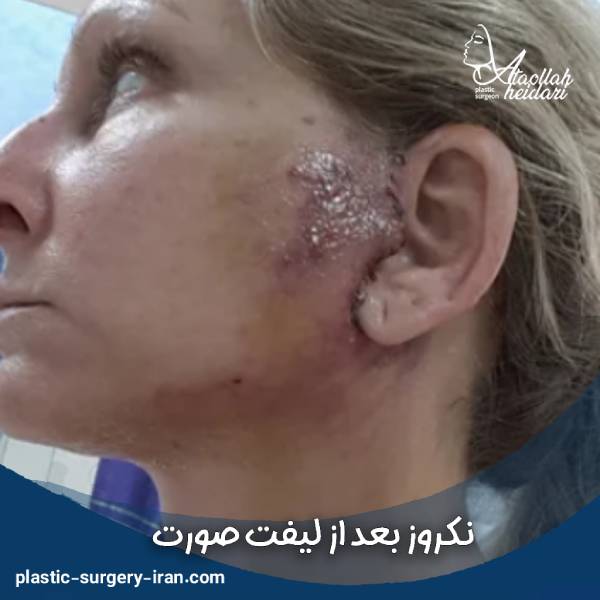عکس نکروز صورت