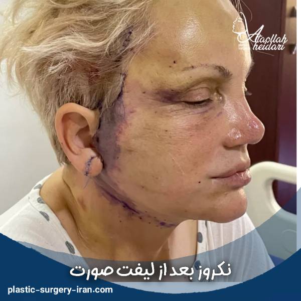 نکروز بعد از لیفت صورت 