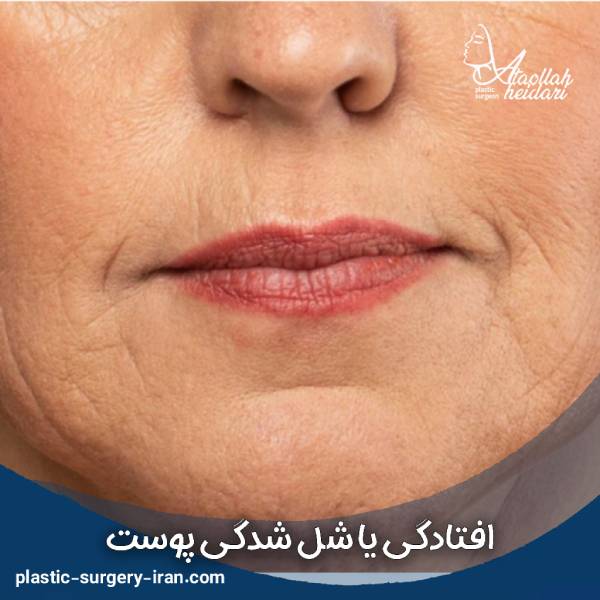شل شدن پوست