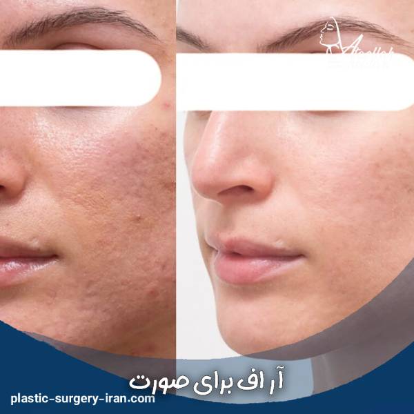 آر اف فرکشنال