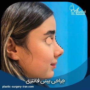 عکس عمل بینی عروسکی