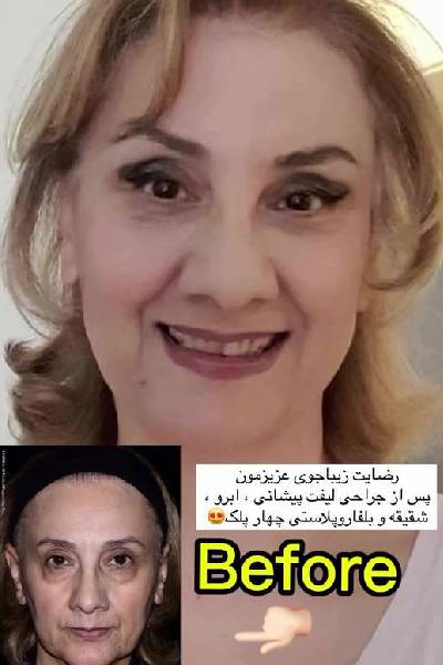 رضایت از جراحی لیفت صورت