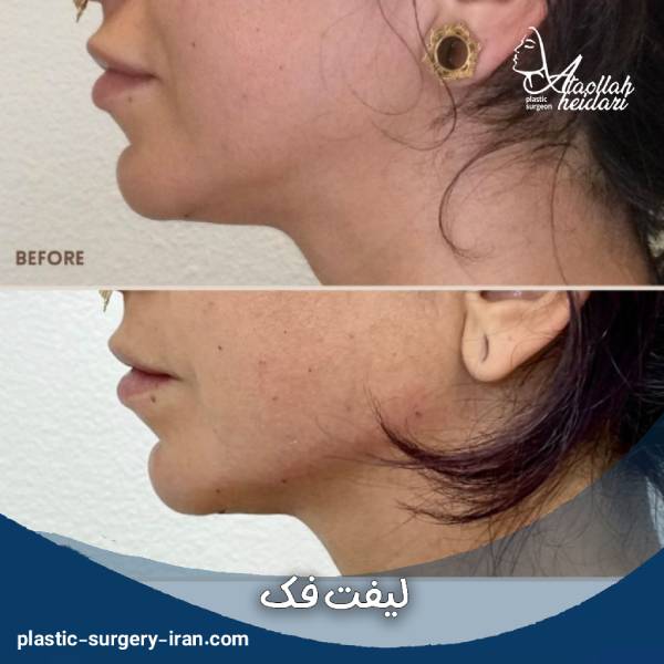 عکس لیفت فک
