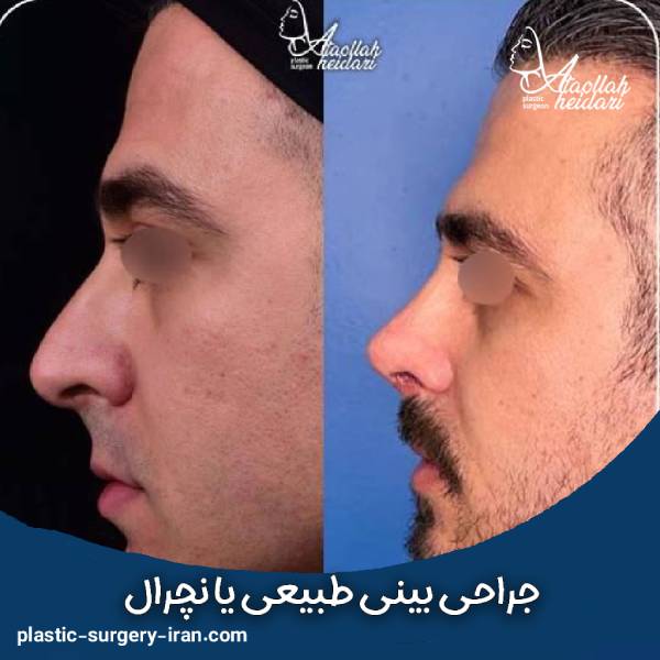 عمل بینی طبیعی