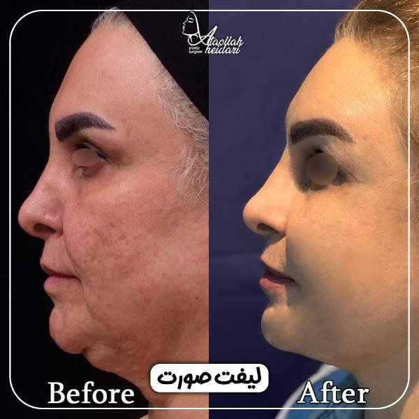 لیفت صورت در مردان و زنان