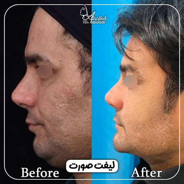 لیفت صورت در مردان