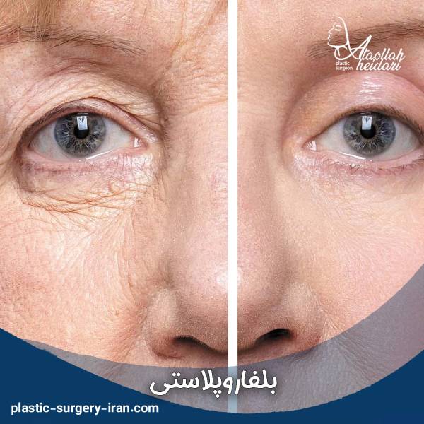 عکس جراحی زیبایی پلک