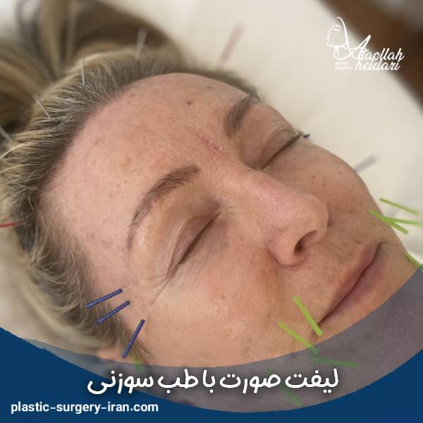 عکس لیفت صورت با طب سوزنی