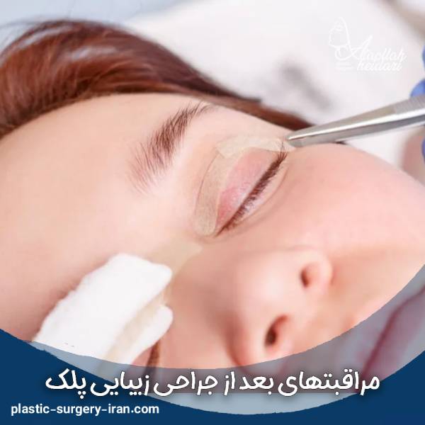 مراقبتهای بعد ازبلفاروپلاستی