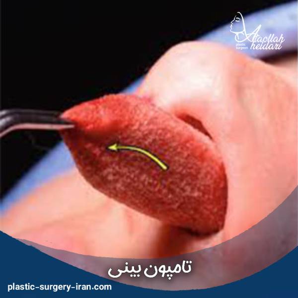 تامپون بینی