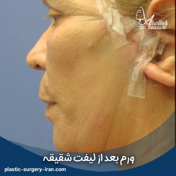 ورم بعد از لیفت شقیقه