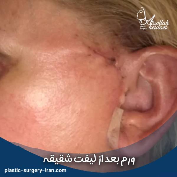 ورم بعد از لیفت شقیقه