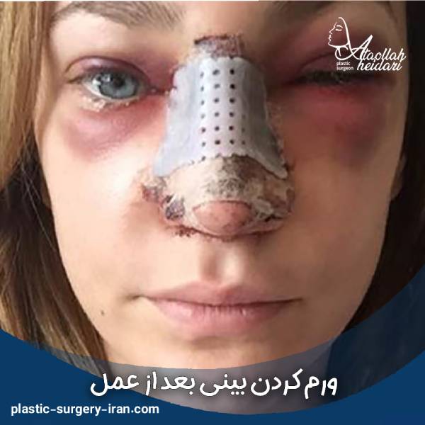 ورم بینی بعد از جراحی