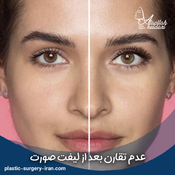 عدم تقارن بعد از لیفت صورت
