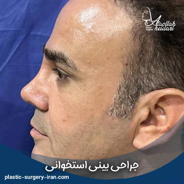 عمل بینی استخوانی