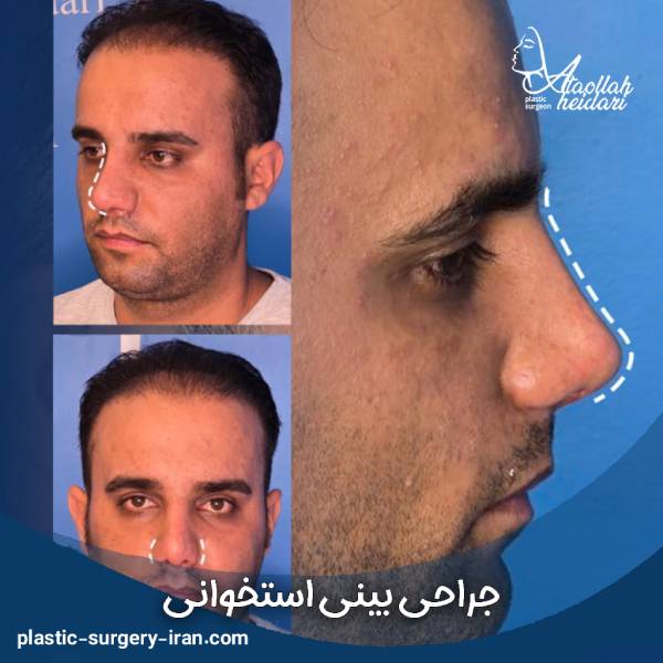 عمل بینی استخوانی