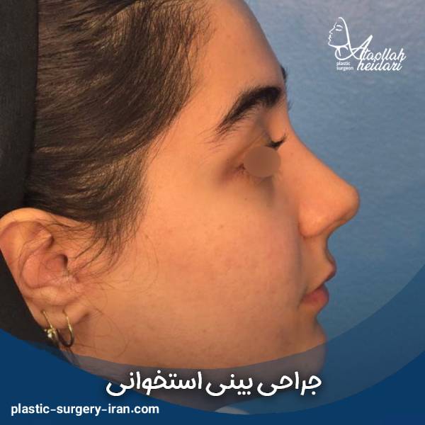 عمل بینی استخوانی