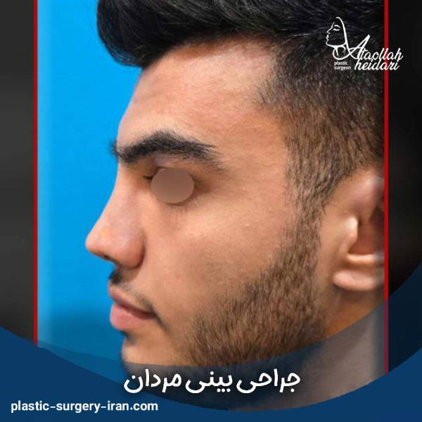 عمل بینی در مردان