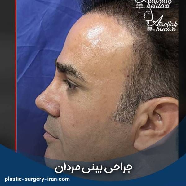 عکس بینی مردانه جراحی شده
