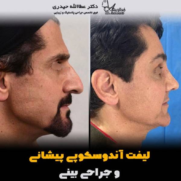 لیفت صورت همزمان با لیفت صورت