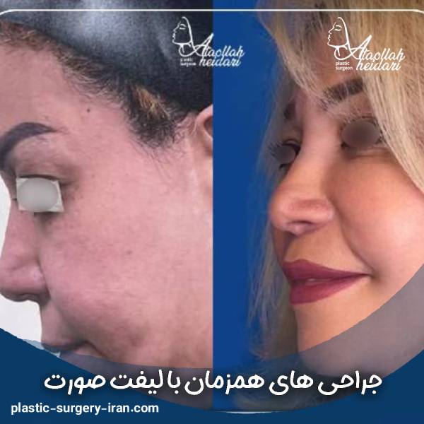 Surgeries performed simultaneously with a facelift