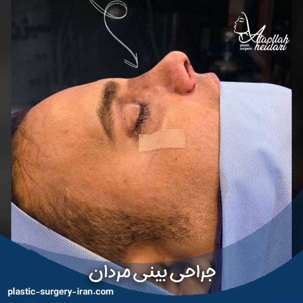 جراحی بینی مردانه